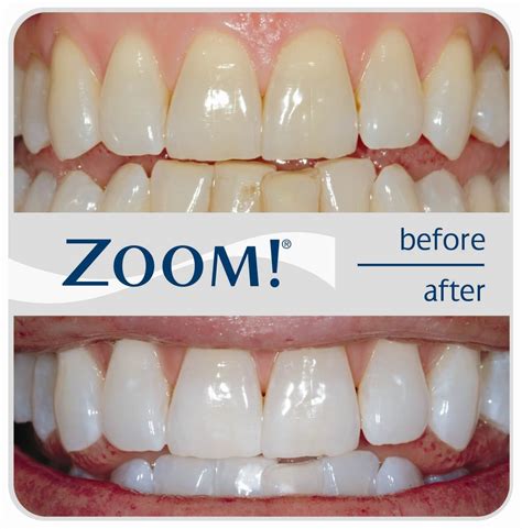 zoom whitening before and after.